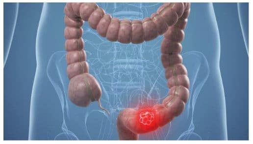 Síntomas del cáncer de colon