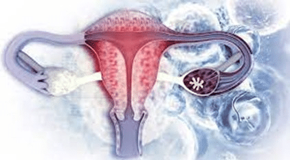Miomas uterinos. Imagen del útero
