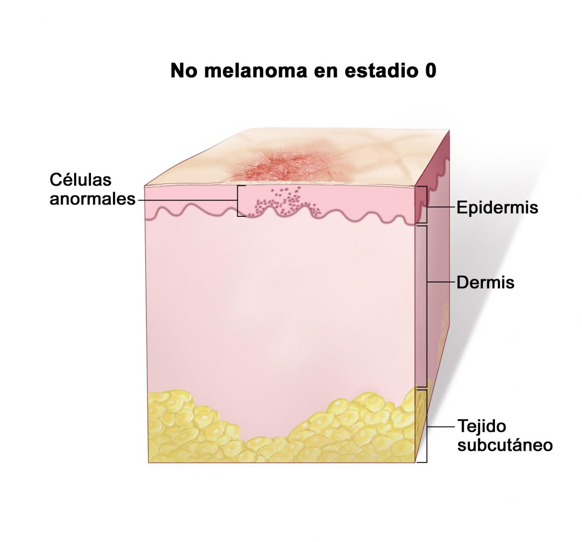 Qué es y como tratar el melanoma maligno El Titular
