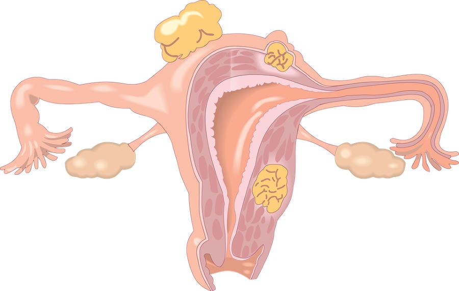 tipos de miomas uterinos