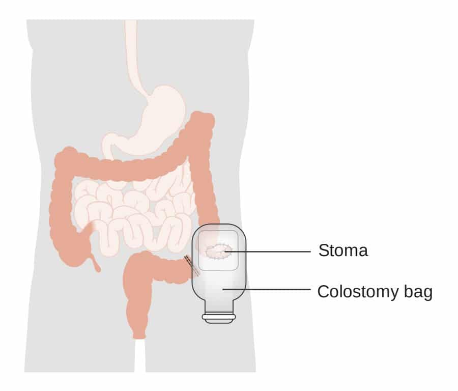 Bolsa de colostomía